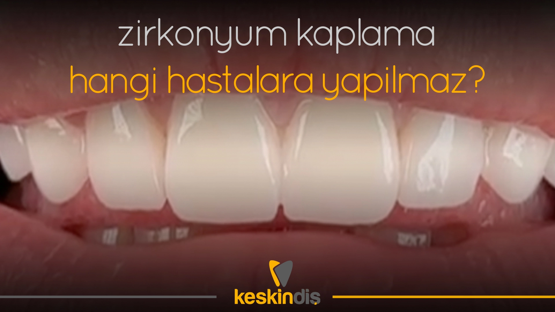 Zirkonyum kaplama hangi hastalara yapılmaz?